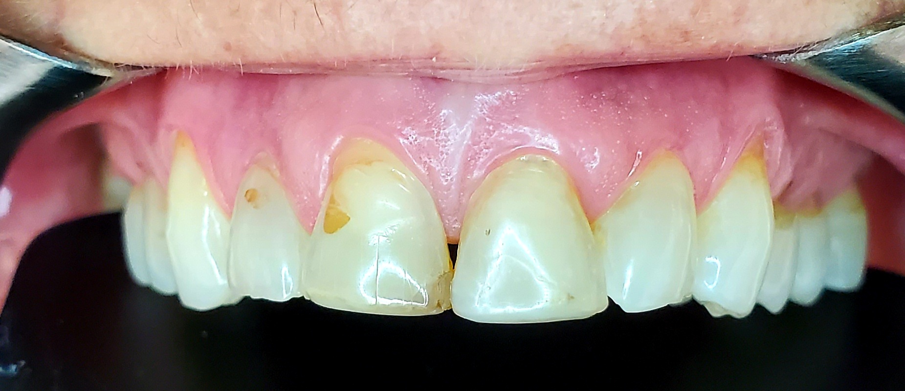 Cosmetic dentistry before treatment at Elm Ridge Implant and Family Dentistry in Killeen, TX